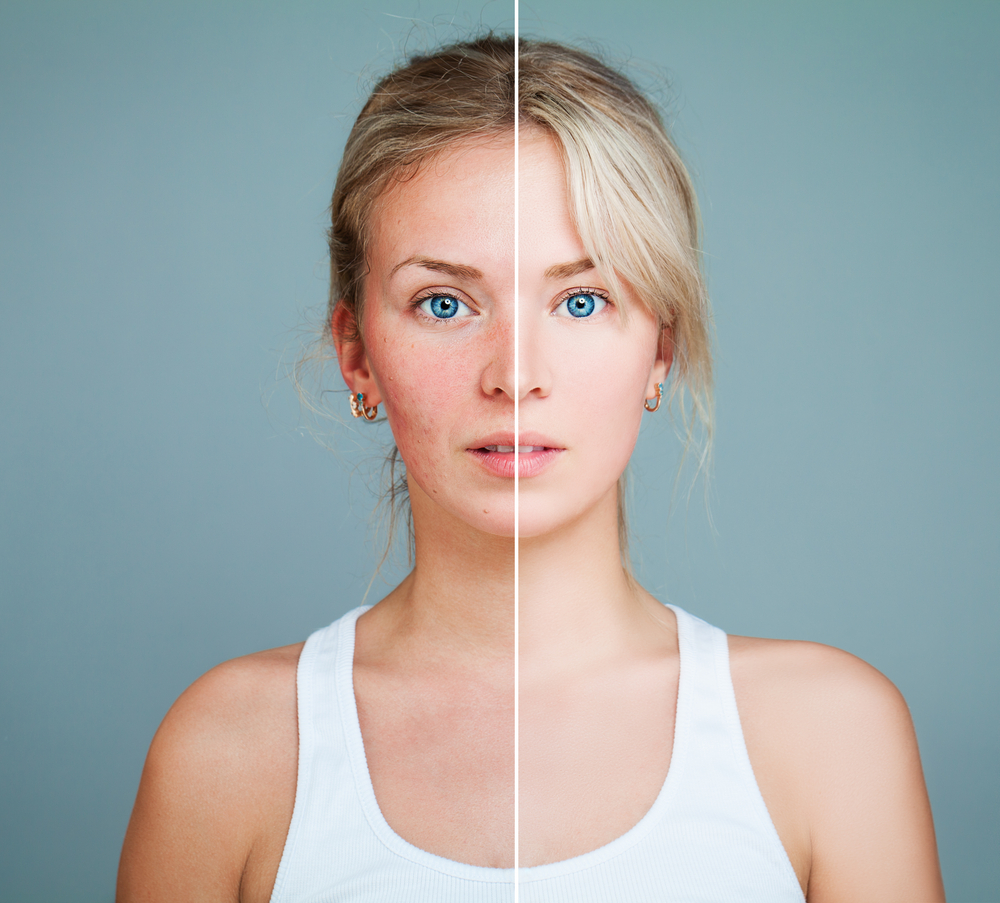 All You Need to Know About Rosacea