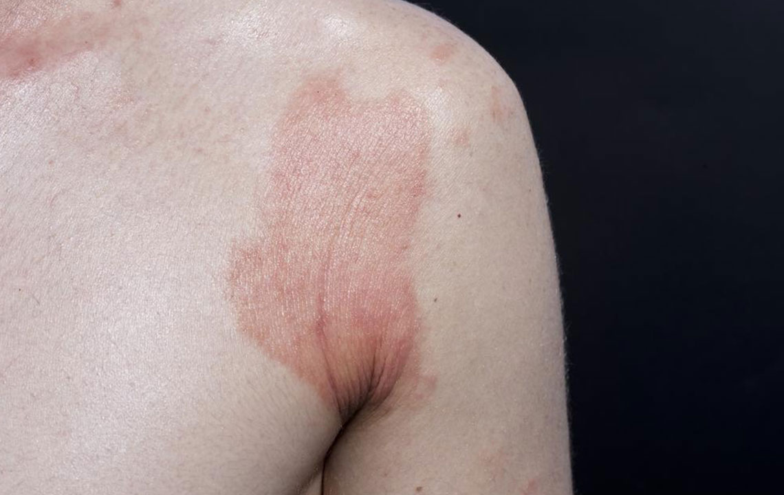 Contact Dermatitis – Symptoms, Causes, and Treatment Options